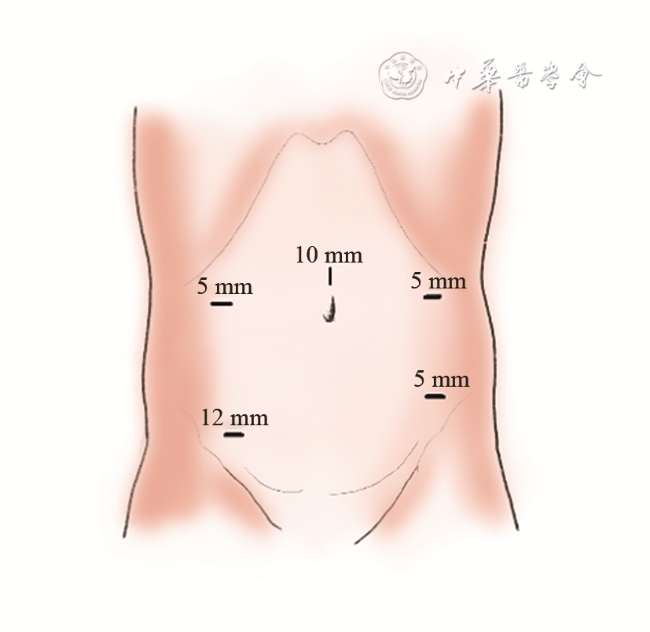 什么是钳口术【专家论坛】直肠癌腹腔镜手术中远端闭合策略-上海聚慕医疗器械有限公司