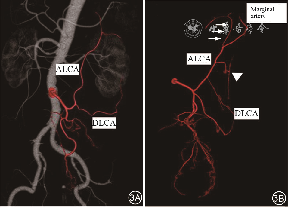 为什么要结扎血管【解剖与手术专栏】左半结肠血管解剖学的再认识及其临床意义_https://www.jmylbn.com_新闻资讯_第3张
