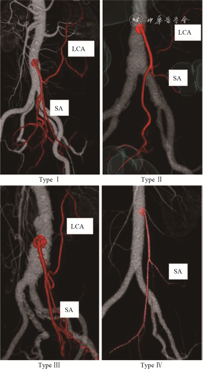 为什么要结扎血管【解剖与手术专栏】左半结肠血管解剖学的再认识及其临床意义_https://www.jmylbn.com_新闻资讯_第2张