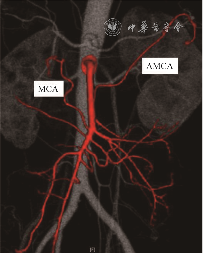 为什么要结扎血管【解剖与手术专栏】左半结肠血管解剖学的再认识及其临床意义_https://www.jmylbn.com_新闻资讯_第1张