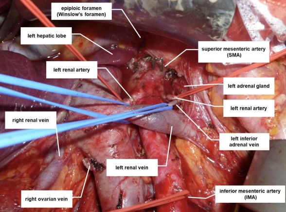 怎么使用妇科探针焦点视界丨宋坤教授：上皮性卵巢癌淋巴结切除术的必要性与临床应用_https://www.jmylbn.com_新闻资讯_第11张