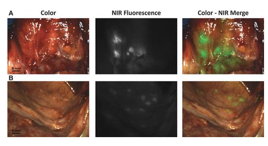 怎么使用妇科探针焦点视界丨宋坤教授：上皮性卵巢癌淋巴结切除术的必要性与临床应用_https://www.jmylbn.com_新闻资讯_第50张