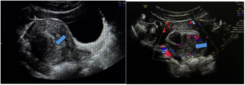 fh染色是什么意思妇瘤新视野丨FH缺陷型子宫平滑肌瘤 vs. 遗传性平滑肌瘤病和肾细胞癌综合征，附2则病例及文献复习_https://www.jmylbn.com_新闻资讯_第4张
