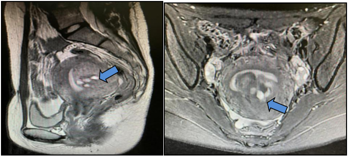 fh染色是什么意思妇瘤新视野丨FH缺陷型子宫平滑肌瘤 vs. 遗传性平滑肌瘤病和肾细胞癌综合征，附2则病例及文献复习_https://www.jmylbn.com_新闻资讯_第5张