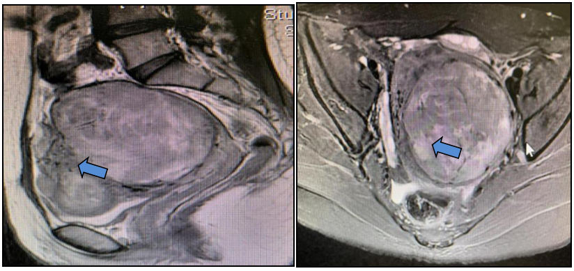 fh染色是什么意思妇瘤新视野丨FH缺陷型子宫平滑肌瘤 vs. 遗传性平滑肌瘤病和肾细胞癌综合征，附2则病例及文献复习_https://www.jmylbn.com_新闻资讯_第9张
