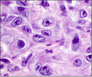 fh染色是什么意思妇瘤新视野丨FH缺陷型子宫平滑肌瘤 vs. 遗传性平滑肌瘤病和肾细胞癌综合征，附2则病例及文献复习_https://www.jmylbn.com_新闻资讯_第11张