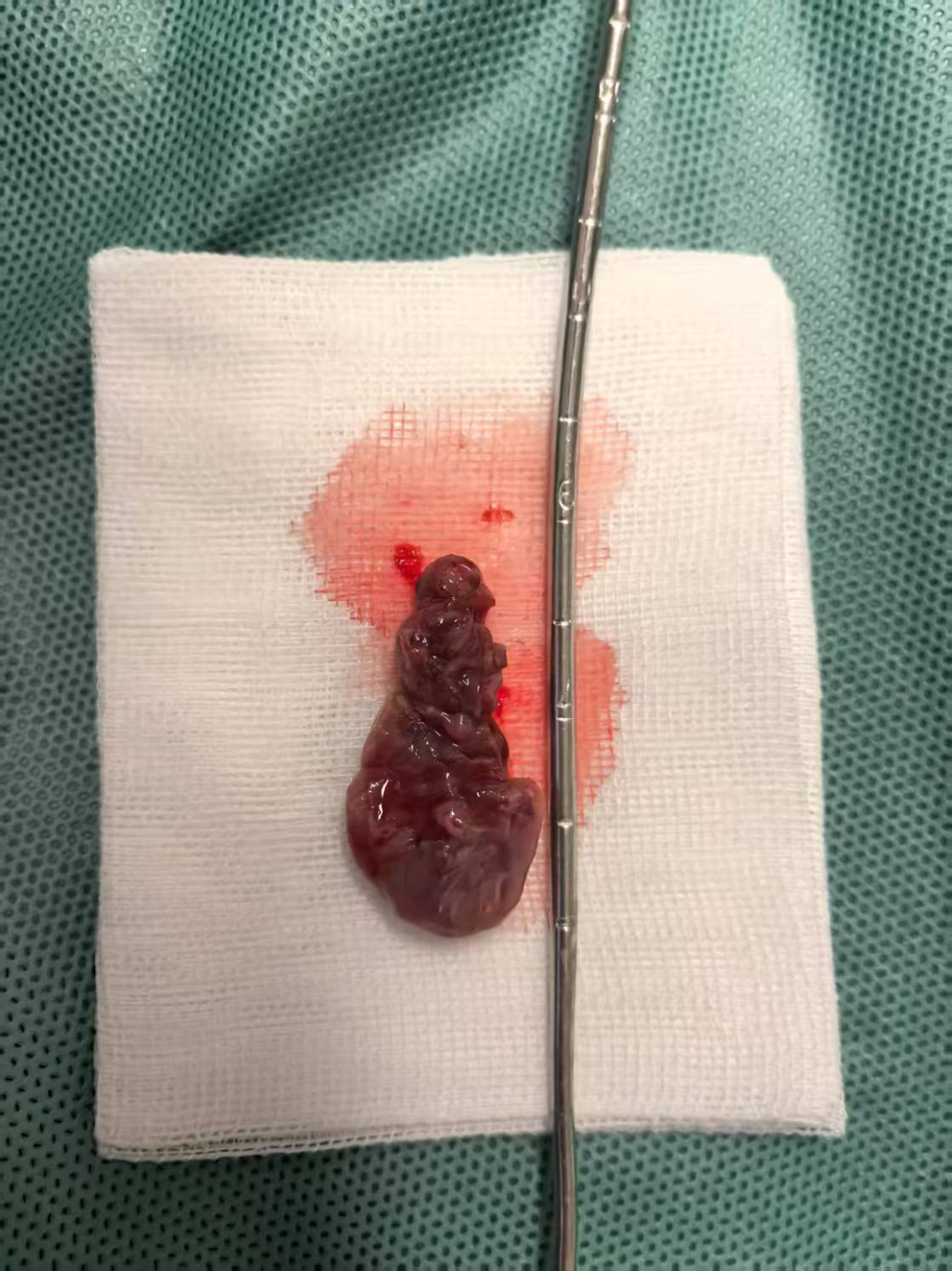 宫内镜怎么进入子宫【素手琴心专场】王素琴主任医师：妊娠期子宫蜕膜息肉的阴道内镜处理策略及时机_https://www.jmylbn.com_新闻资讯_第12张