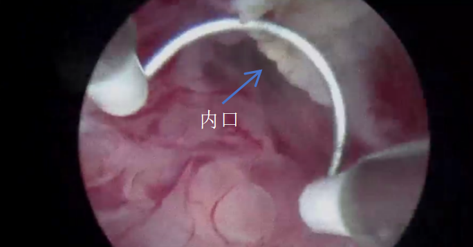 宫内镜怎么进入子宫【素手琴心专场】王素琴主任医师：妊娠期子宫蜕膜息肉的阴道内镜处理策略及时机_https://www.jmylbn.com_新闻资讯_第11张