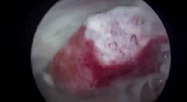 宫内镜怎么进入子宫【素手琴心专场】王素琴主任医师：妊娠期子宫蜕膜息肉的阴道内镜处理策略及时机_https://www.jmylbn.com_新闻资讯_第8张