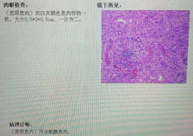 宫内镜怎么进入子宫【素手琴心专场】王素琴主任医师：妊娠期子宫蜕膜息肉的阴道内镜处理策略及时机_https://www.jmylbn.com_新闻资讯_第13张