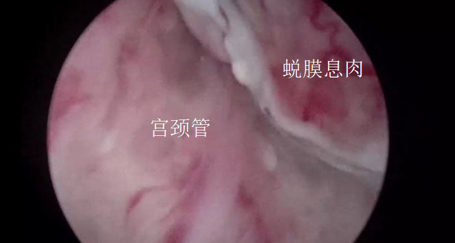 宫内镜怎么进入子宫【素手琴心专场】王素琴主任医师：妊娠期子宫蜕膜息肉的阴道内镜处理策略及时机_https://www.jmylbn.com_新闻资讯_第9张