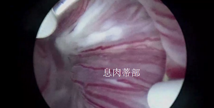 宫内镜怎么进入子宫【素手琴心专场】王素琴主任医师：妊娠期子宫蜕膜息肉的阴道内镜处理策略及时机_https://www.jmylbn.com_新闻资讯_第10张