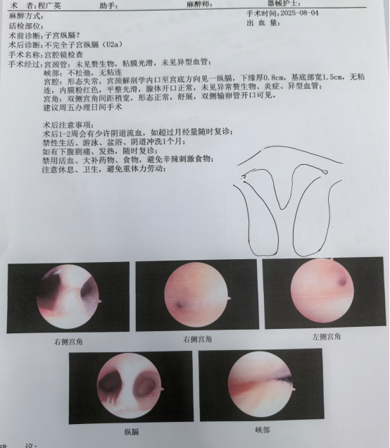 双极刀怎么画砚都宫程，张显技术丨程广英医生：不全纵隔诊疗新理念：阴道内镜小冷刀+双极等离子电刀处理优势及相关思考_https://www.jmylbn.com_新闻资讯_第5张