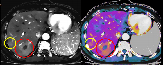 飞利浦ct有哪些型号浙江省首台飞利浦皓克Spectral 256排光谱CT落户丽水这家医院！_https://www.jmylbn.com_新闻资讯_第10张