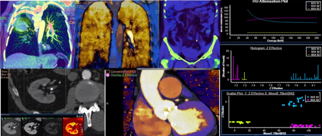 飞利浦ct有哪些型号浙江省首台飞利浦皓克Spectral 256排光谱CT落户丽水这家医院！_https://www.jmylbn.com_新闻资讯_第8张