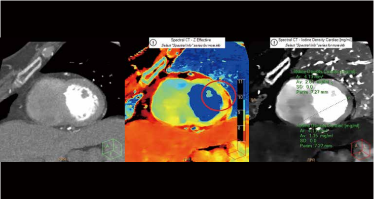 飞利浦ct有哪些型号浙江省首台飞利浦皓克Spectral 256排光谱CT落户丽水这家医院！_https://www.jmylbn.com_新闻资讯_第9张