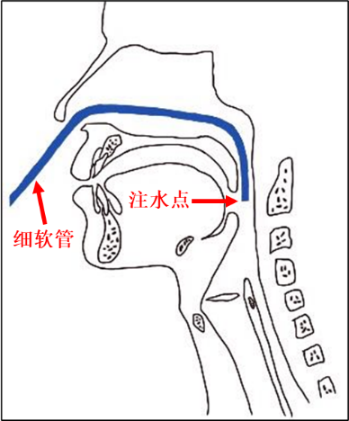 为什么要做吞咽仪器脑损伤后气管切开患者的吞咽功能康复（一）——评估篇_https://www.jmylbn.com_新闻资讯_第4张