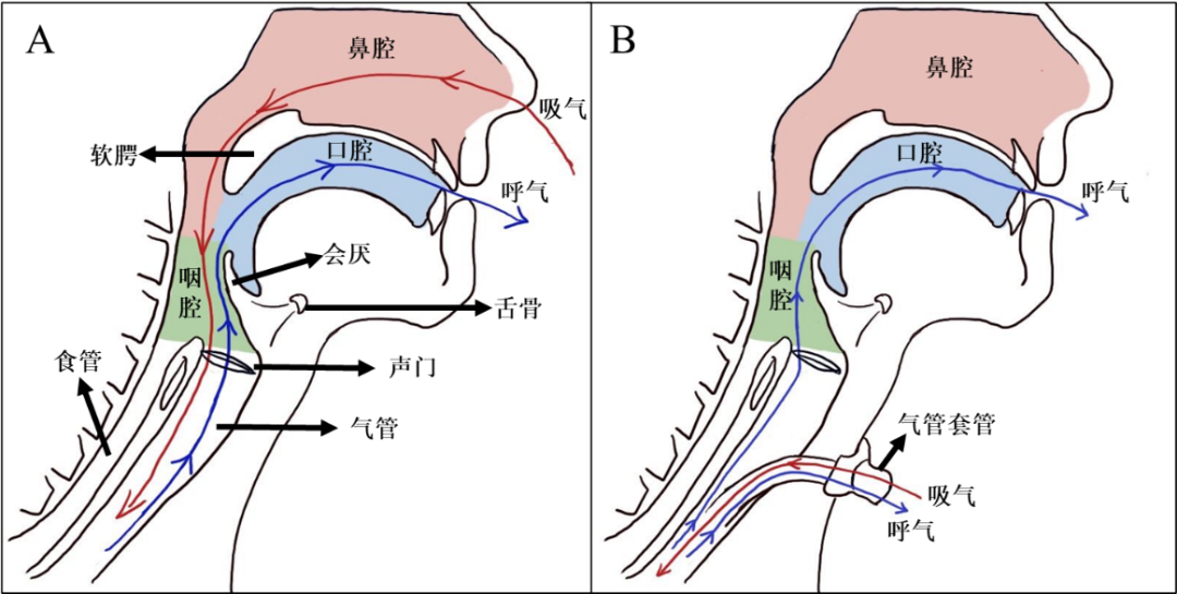 为什么要做吞咽仪器脑损伤后气管切开患者的吞咽功能康复（一）——评估篇_https://www.jmylbn.com_新闻资讯_第2张