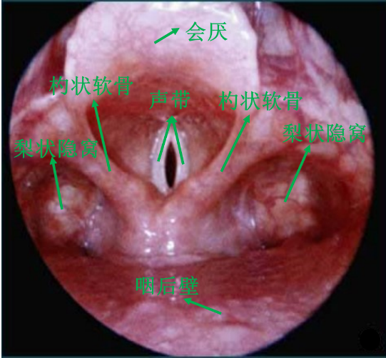 为什么要做吞咽仪器脑损伤后气管切开患者的吞咽功能康复（一）——评估篇_https://www.jmylbn.com_新闻资讯_第12张