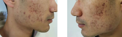 二氧化碳(co2)激光治疗是什么点阵二氧化碳激光（CO2)你了解吗？_https://www.jmylbn.com_新闻资讯_第1张