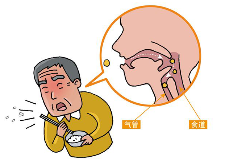 为什么要做吞咽仪器【阳光·科普】警惕老年人吃汤圆噎食！吞咽障碍早发现，教你初步自查→_https://www.jmylbn.com_新闻资讯_第4张