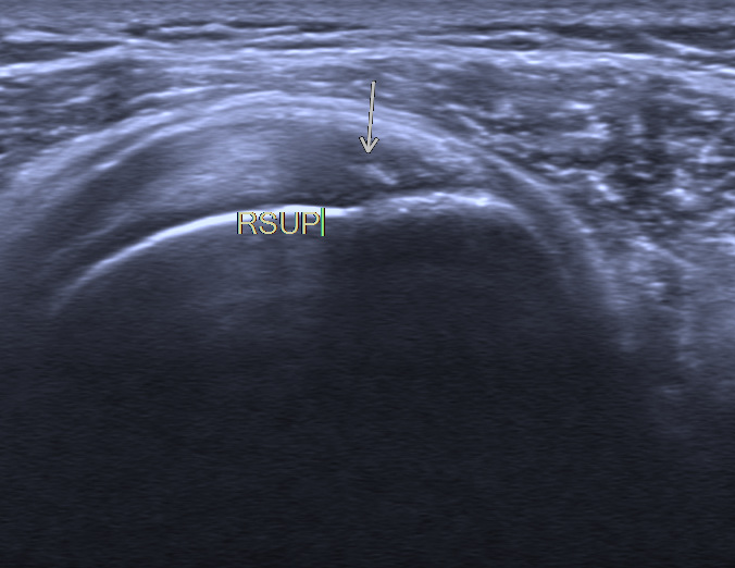康复仪探头怎么拿【阳光·科普】小探头大作用——超声看肩周炎_https://www.jmylbn.com_新闻资讯_第5张