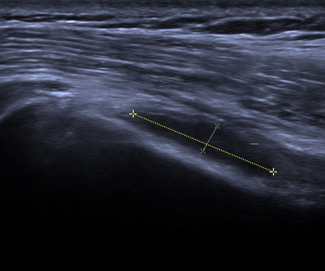 康复仪探头怎么拿【阳光·科普】小探头大作用——超声看肩周炎_https://www.jmylbn.com_新闻资讯_第4张