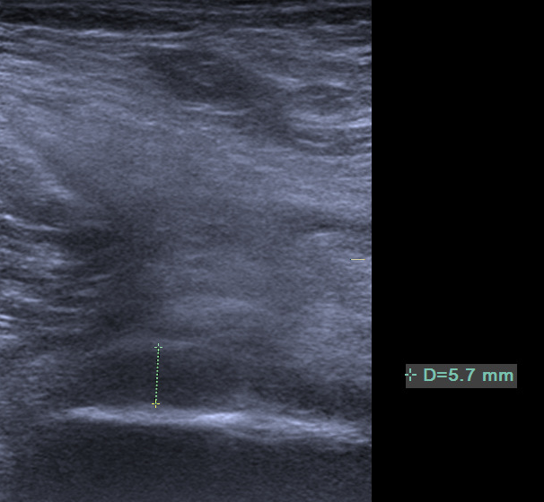 康复仪探头怎么拿【阳光·科普】小探头大作用——超声看肩周炎_https://www.jmylbn.com_新闻资讯_第7张