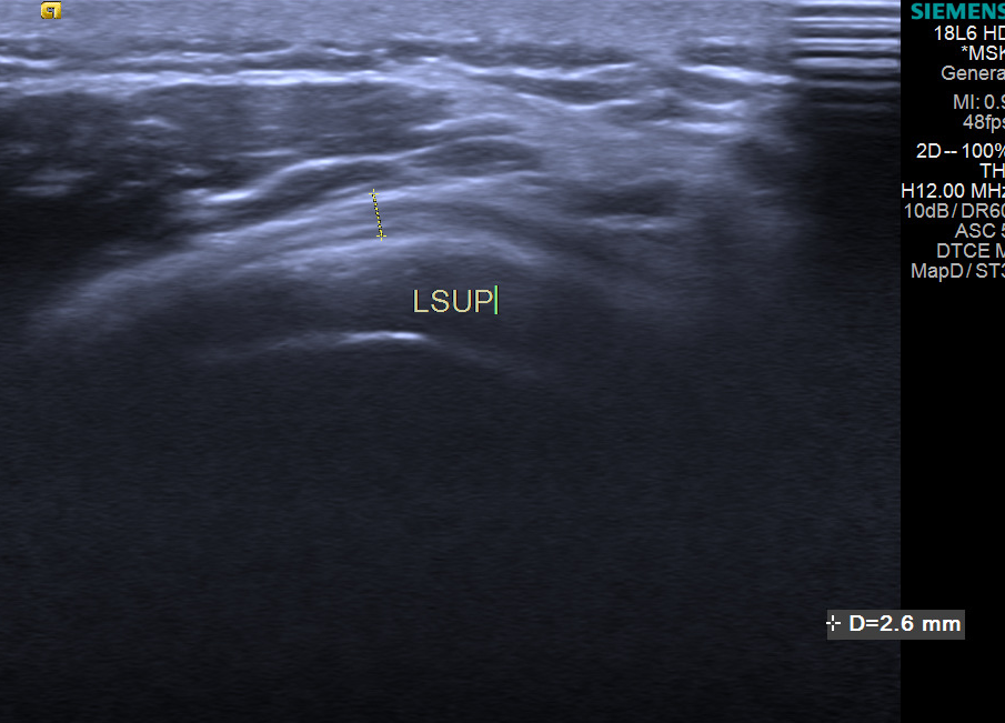 康复仪探头怎么拿【阳光·科普】小探头大作用——超声看肩周炎_https://www.jmylbn.com_新闻资讯_第6张