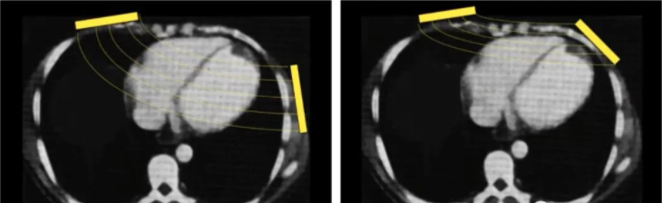 aed电极贴怎么贴AED的电极片，你贴的对吗？_https://www.jmylbn.com_新闻资讯_第7张