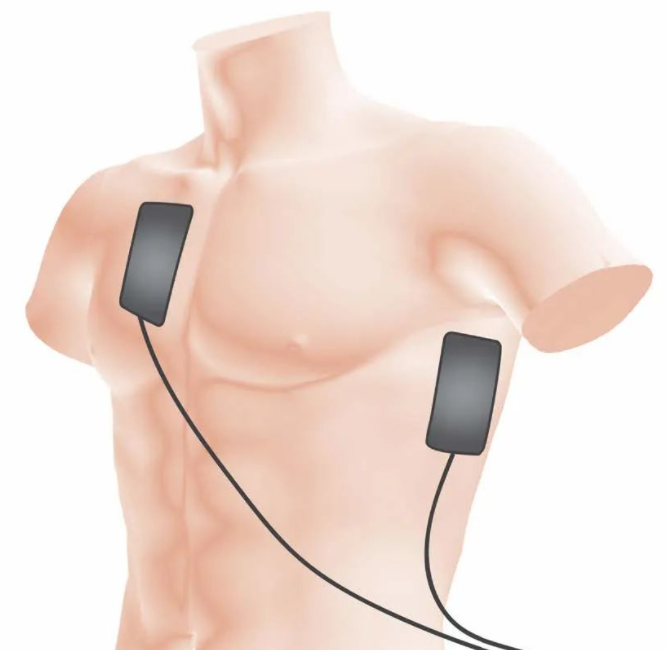 aed电极贴怎么贴AED的电极片，你贴的对吗？_https://www.jmylbn.com_新闻资讯_第6张