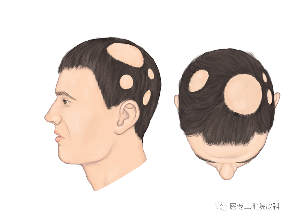常见毛发疾病—斑秃（二）