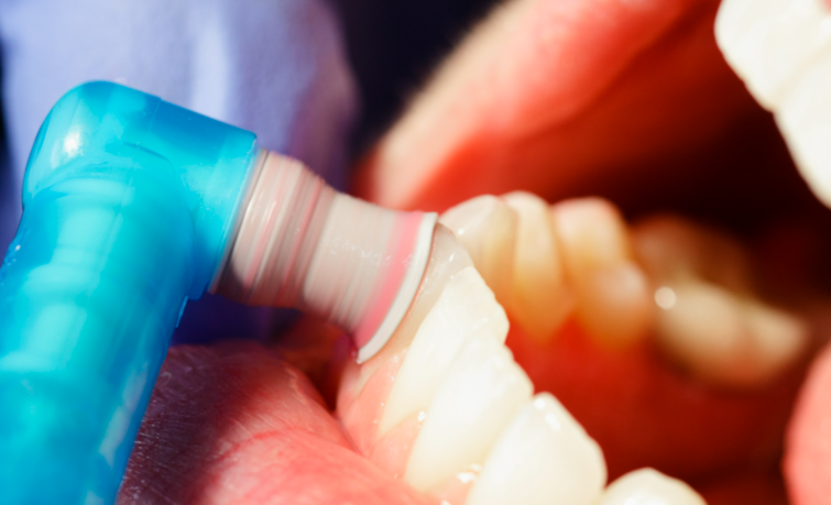 怎么选洁牙器械同样是洗牙，价格差距怎么这么大？_https://www.jmylbn.com_新闻资讯_第7张