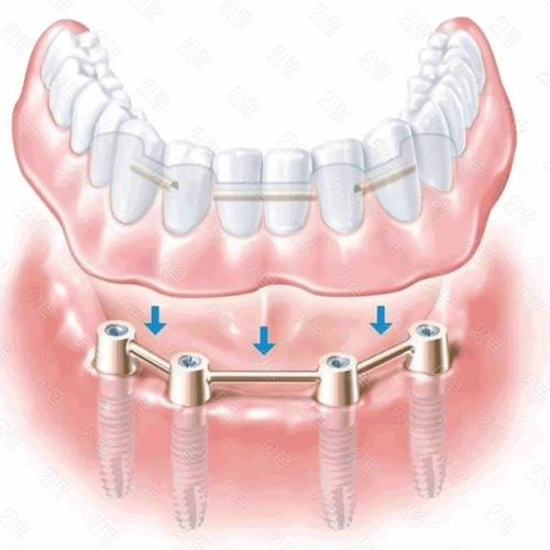 种植覆盖全口义齿通常仅需要单颌植入2-4颗种植体,种植体上连接不同的