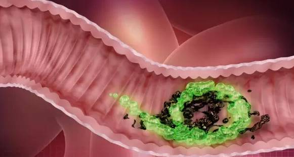 肠道毒素堆积居然是癌症的根源