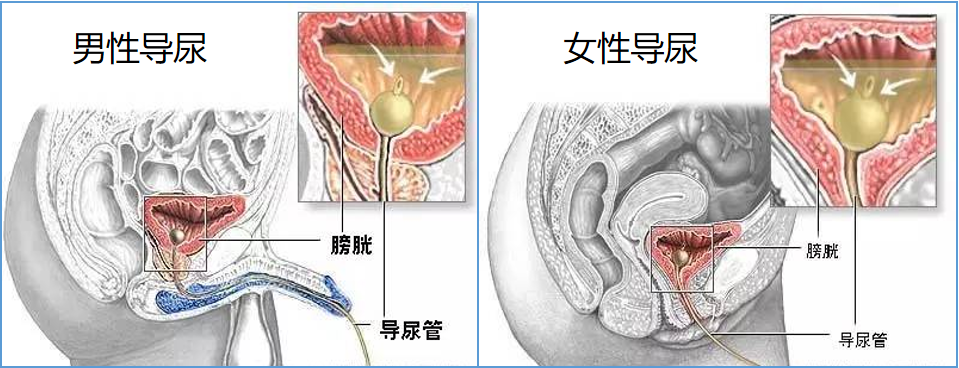 为什么要引流尿袋小管子，大作用——导尿管知识问答_https://www.jmylbn.com_新闻资讯_第3张