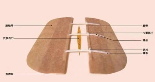 医用缝合扣怎么用瘢痕防治新武器-皮肤减张缝合器_https://www.jmylbn.com_新闻资讯_第6张