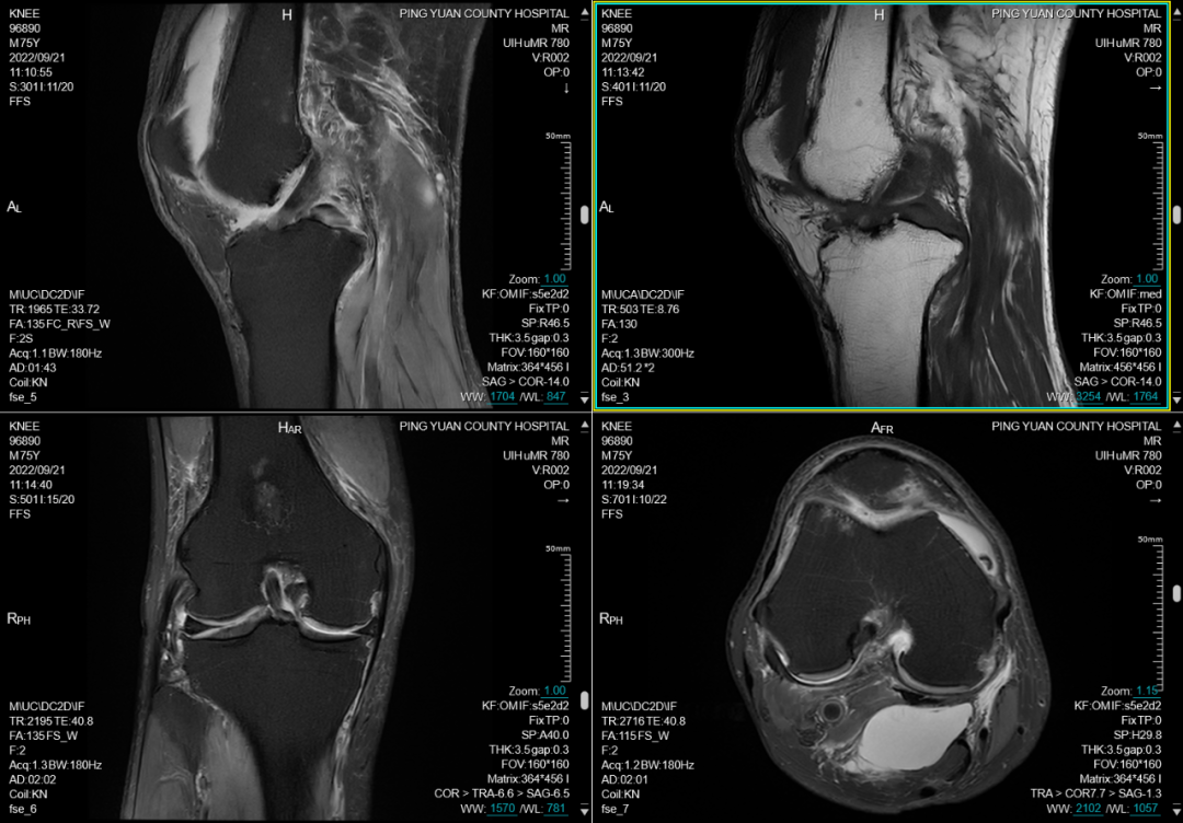联影磁共振怎么样平原县第一人民医院联影uMR780 光梭3.0T磁共振正式投入使用，开启医学影像新时代！_https://www.jmylbn.com_新闻资讯_第12张