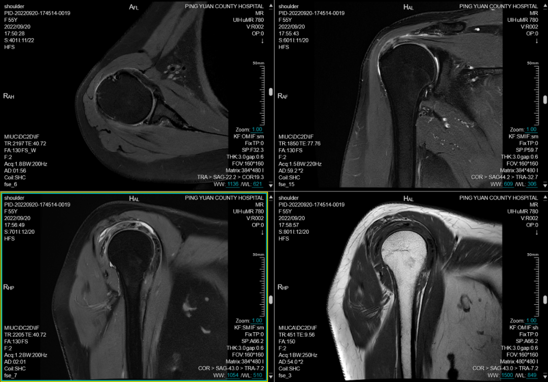 联影磁共振怎么样平原县第一人民医院联影uMR780 光梭3.0T磁共振正式投入使用，开启医学影像新时代！_https://www.jmylbn.com_新闻资讯_第14张