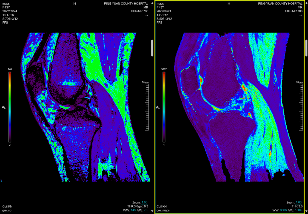 联影磁共振怎么样平原县第一人民医院联影uMR780 光梭3.0T磁共振正式投入使用，开启医学影像新时代！_https://www.jmylbn.com_新闻资讯_第13张