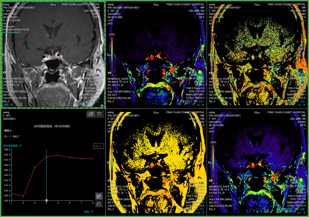 联影磁共振怎么样平原县第一人民医院联影uMR780 光梭3.0T磁共振正式投入使用，开启医学影像新时代！_https://www.jmylbn.com_新闻资讯_第26张