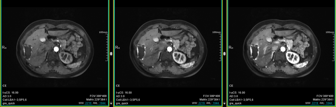 联影磁共振怎么样平原县第一人民医院联影uMR780 光梭3.0T磁共振正式投入使用，开启医学影像新时代！_https://www.jmylbn.com_新闻资讯_第27张