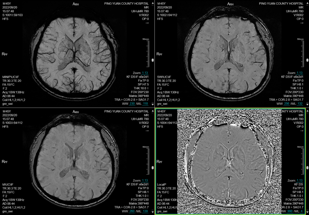 联影磁共振怎么样平原县第一人民医院联影uMR780 光梭3.0T磁共振正式投入使用，开启医学影像新时代！_https://www.jmylbn.com_新闻资讯_第8张