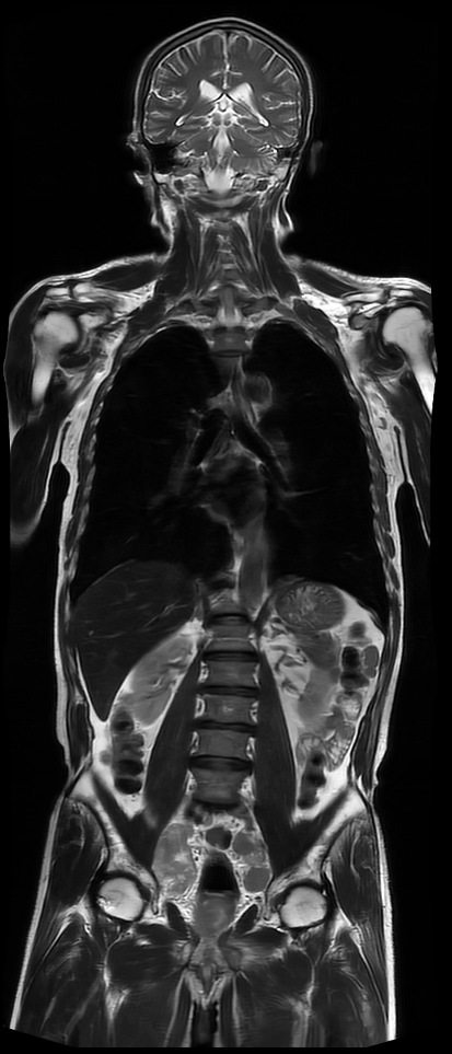 联影磁共振怎么样平原县第一人民医院联影uMR780 光梭3.0T磁共振正式投入使用，开启医学影像新时代！_https://www.jmylbn.com_新闻资讯_第17张