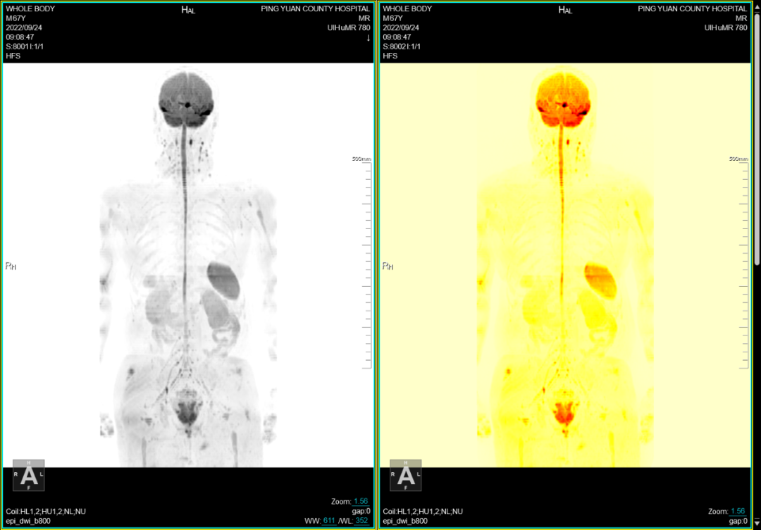 联影磁共振怎么样平原县第一人民医院联影uMR780 光梭3.0T磁共振正式投入使用，开启医学影像新时代！_https://www.jmylbn.com_新闻资讯_第23张