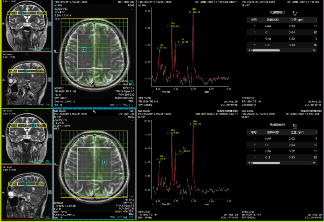 联影磁共振怎么样平原县第一人民医院联影uMR780 光梭3.0T磁共振正式投入使用，开启医学影像新时代！_https://www.jmylbn.com_新闻资讯_第9张