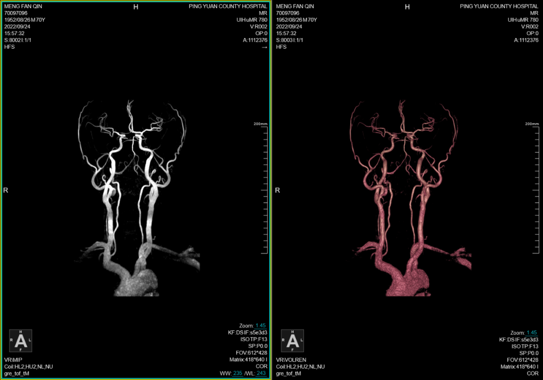 联影磁共振怎么样平原县第一人民医院联影uMR780 光梭3.0T磁共振正式投入使用，开启医学影像新时代！_https://www.jmylbn.com_新闻资讯_第6张