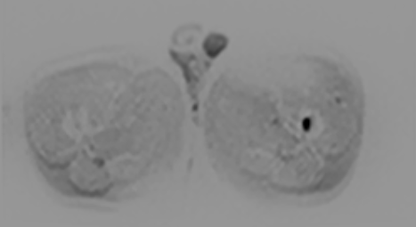 联影磁共振怎么样平原县第一人民医院联影uMR780 光梭3.0T磁共振正式投入使用，开启医学影像新时代！_https://www.jmylbn.com_新闻资讯_第22张