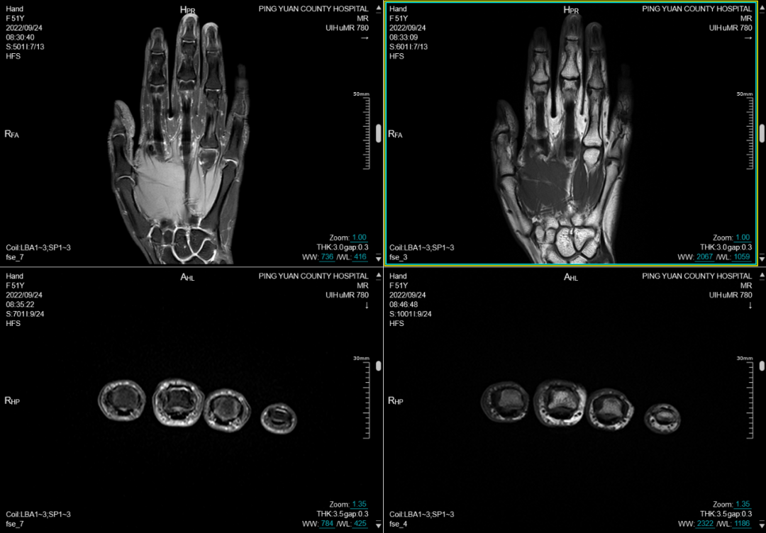 联影磁共振怎么样平原县第一人民医院联影uMR780 光梭3.0T磁共振正式投入使用，开启医学影像新时代！_https://www.jmylbn.com_新闻资讯_第15张