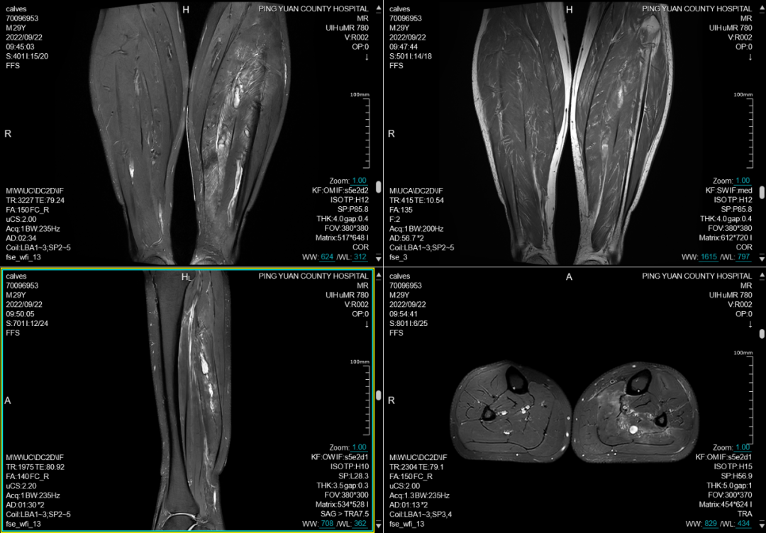 联影磁共振怎么样平原县第一人民医院联影uMR780 光梭3.0T磁共振正式投入使用，开启医学影像新时代！_https://www.jmylbn.com_新闻资讯_第16张